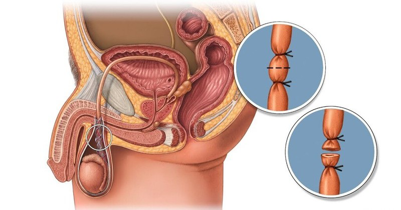 Rincón de respuestas: ¿Existe-t-il un gomodo d'implant anticonceptivo para hombres? 4